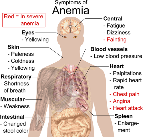 Symptoms-of-anemia Symptoms of anemia