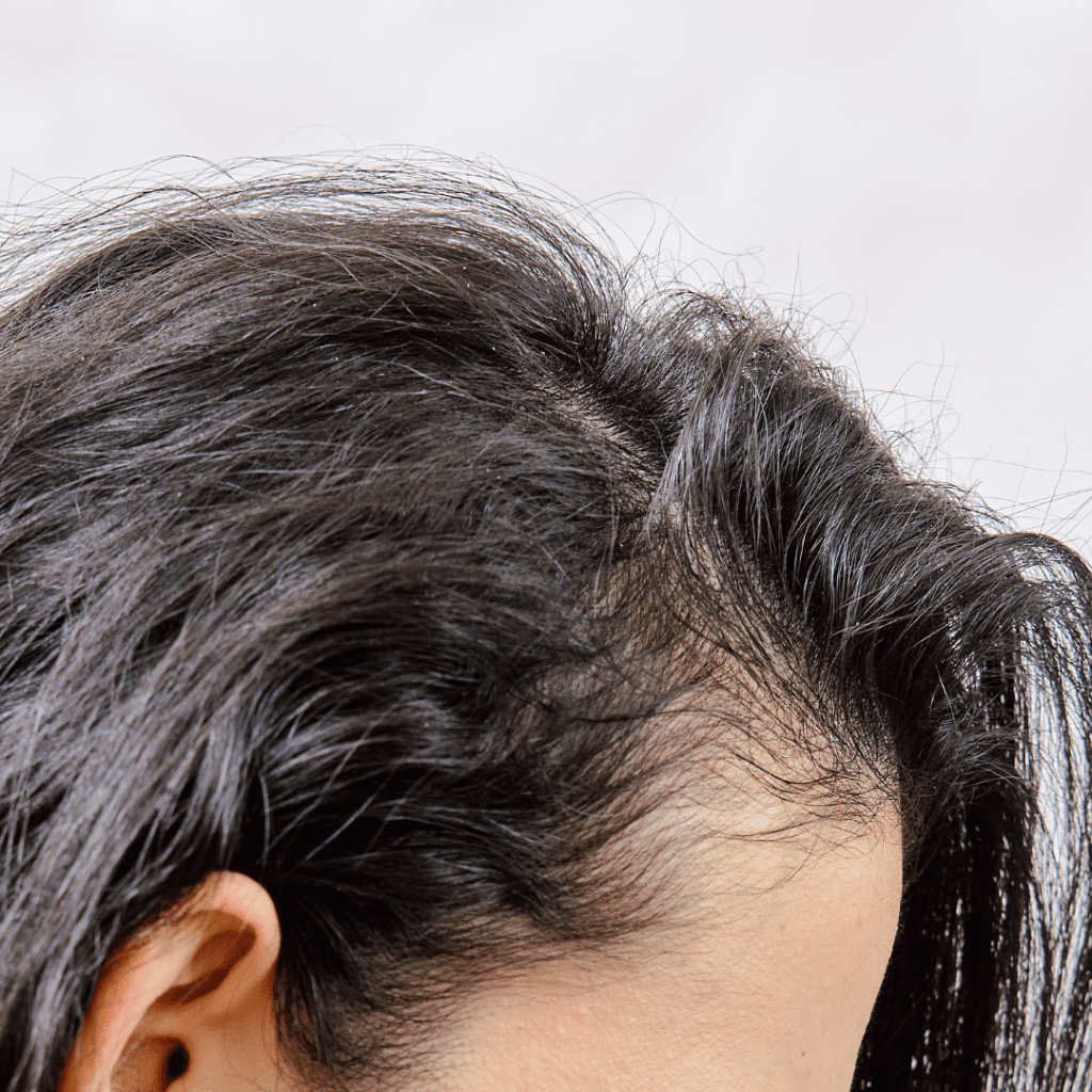 Iron deficiency hair loss